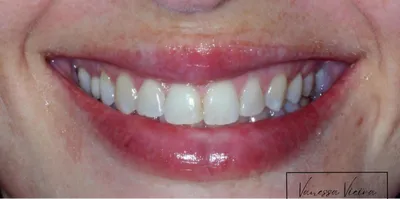Antes: dentes amarelados e de bordos desiguais