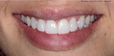 Depois: os mesmos dentes mais claros, com a cor e a forma uniformes