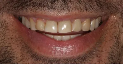 Antes: dentes da frente curtos e gastos, num homem de barba