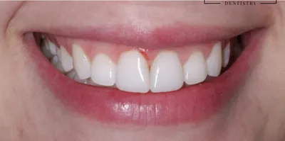 Depois: os dois dentes da frente reconstruídos e mais claros