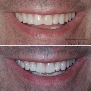 Os mesmos dentes logo após o tratamento e 14 meses depois