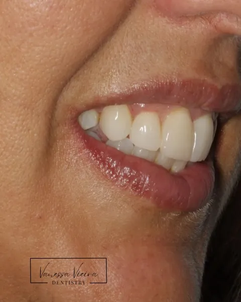 Sorriso visto de perfil, depois de um tratamento em resina composta